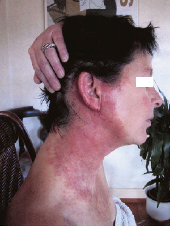Figure 9.6 Allergic reaction reported after use of a hair colouring product
 by a hairdresser