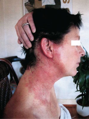 Figur 9.6 Rapportert allergisk reaksjon på hårfargestoff
 etter hårfarging hos frisør