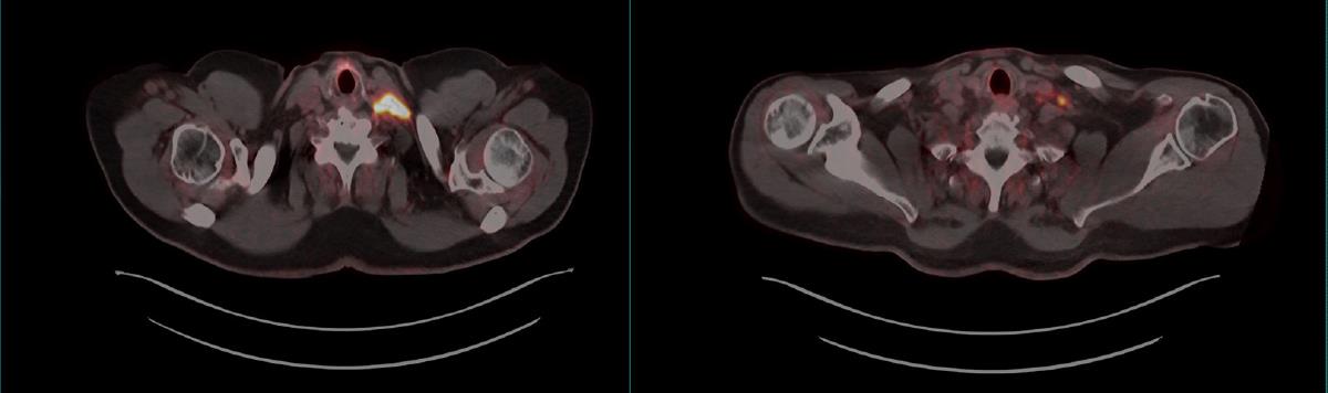 Figuren er to røntgenbiler av PET-typen, der kreftceller fra prostata er merket gulrødt av 68Ga-PSMA, mens resten av vevet er i sort-hvitt. Venstre del av figuren er før spesifikk 177Lu-PSMA behandling, høyre del er etter behandling. Det er mer gulrødt vev på den venstre delen av figuren enn på den høyre figuren, som indikasjon på at behandlingen har virket.